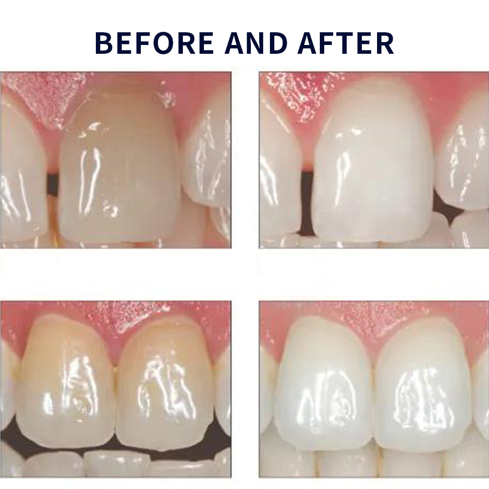 Opalescence Whitening 20% PF 2 - огляд і ціна Teeth Whitening Results