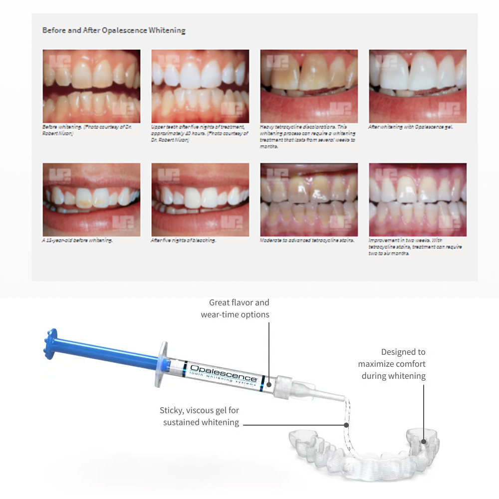 Opalescence Whitening 20% PF 2 - огляд і ціна Teeth Whitening Results