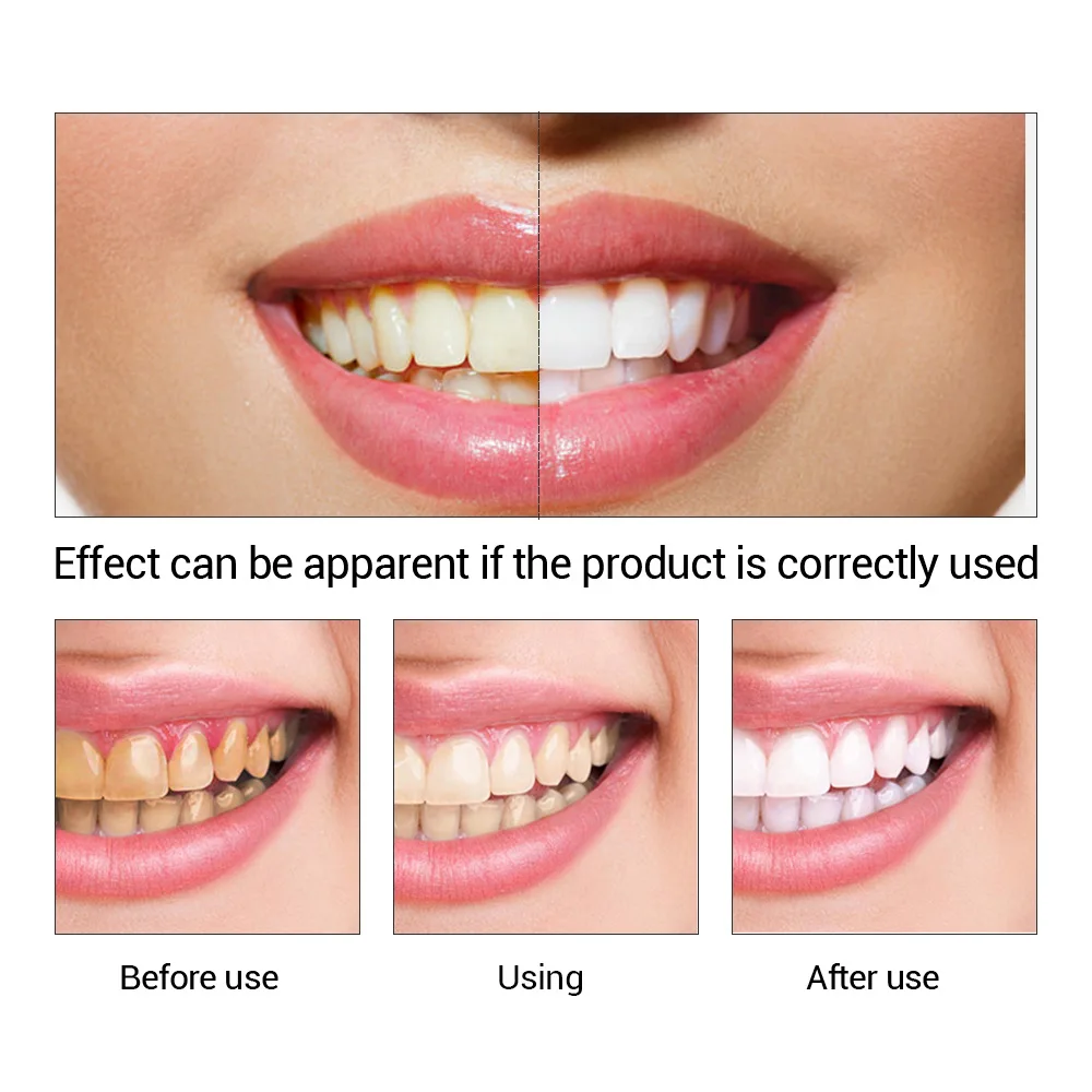 FTEENPLY Teeth Whitening Essen - огляд і ціна Teeth Whitening Results