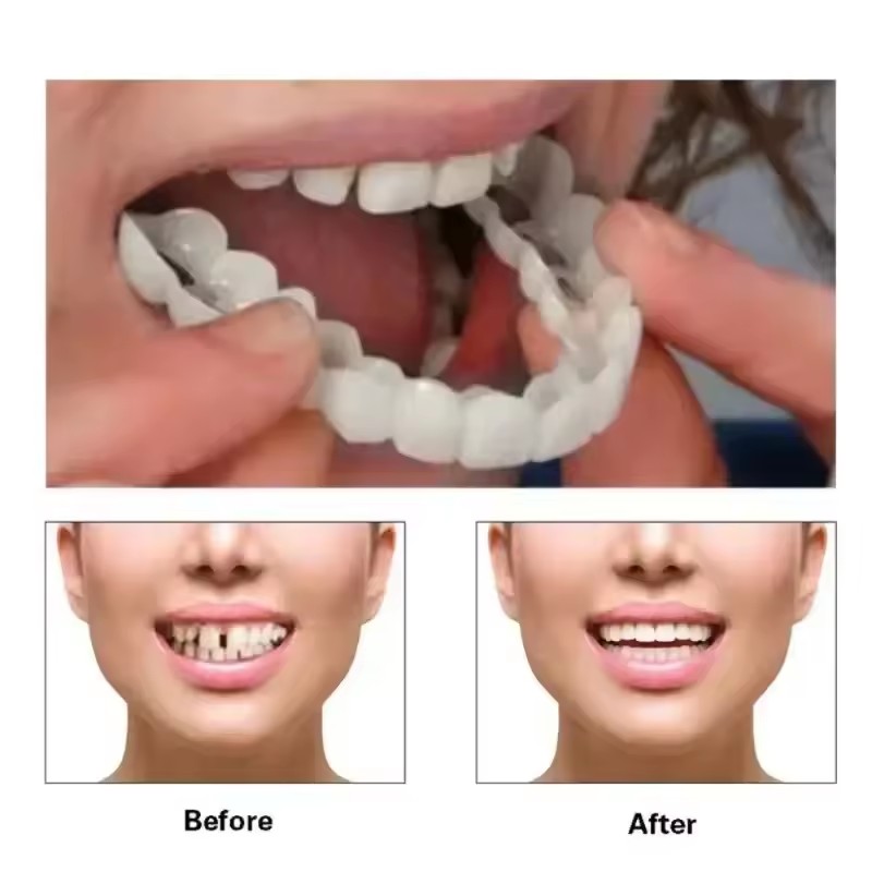 Teeth Veneers Whitening Dentur - огляд і ціна Teeth Whitening Veneers
