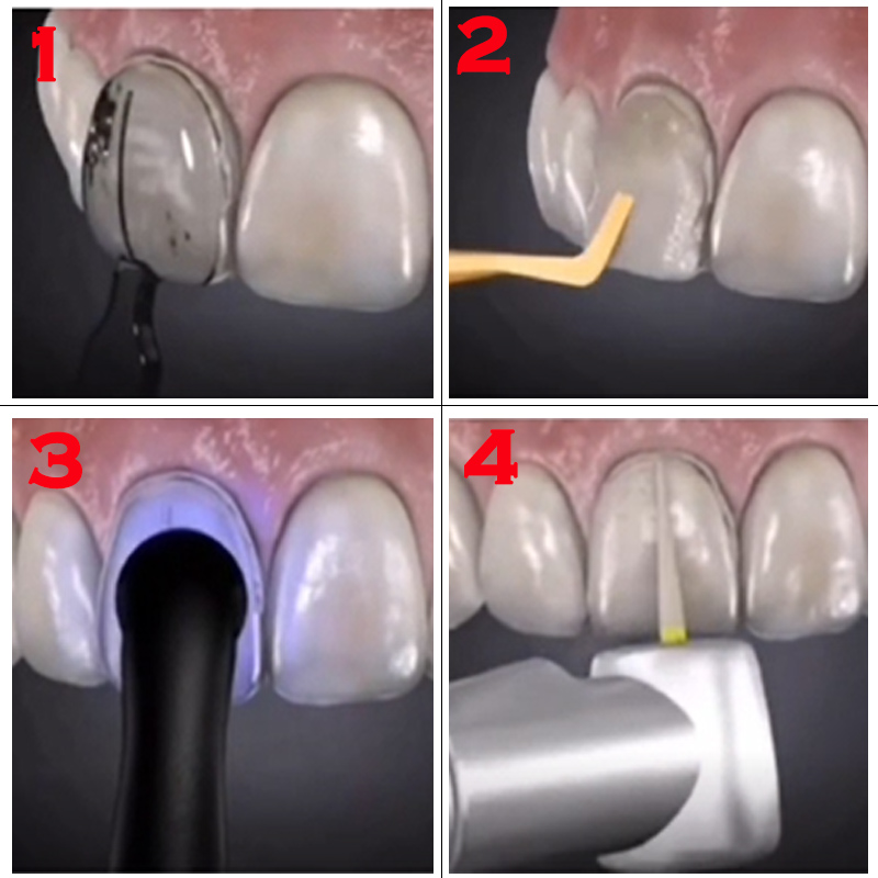 Dental Mold for Composite Resi - огляд і ціна Teeth Whitening Veneers