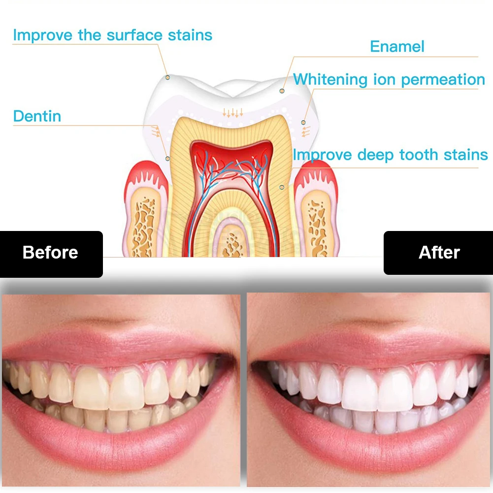 Dental Teeth Whitening Kit Min - огляд і ціна Teeth Whitening Accelerator
